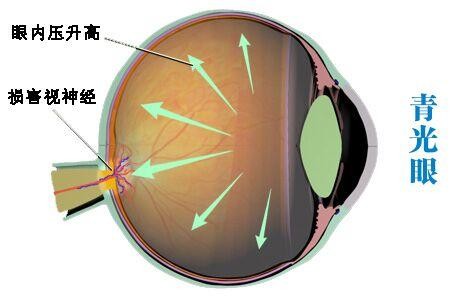 開(kāi)角型青光眼最新治療方法探討與解析